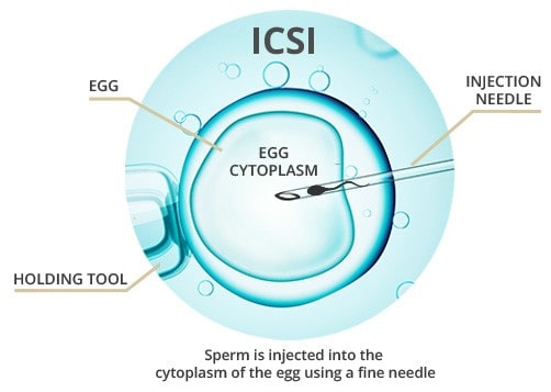 ICSI Treatment