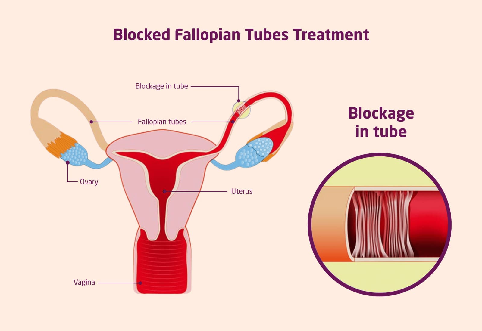 Blocked Fallopian Tubes