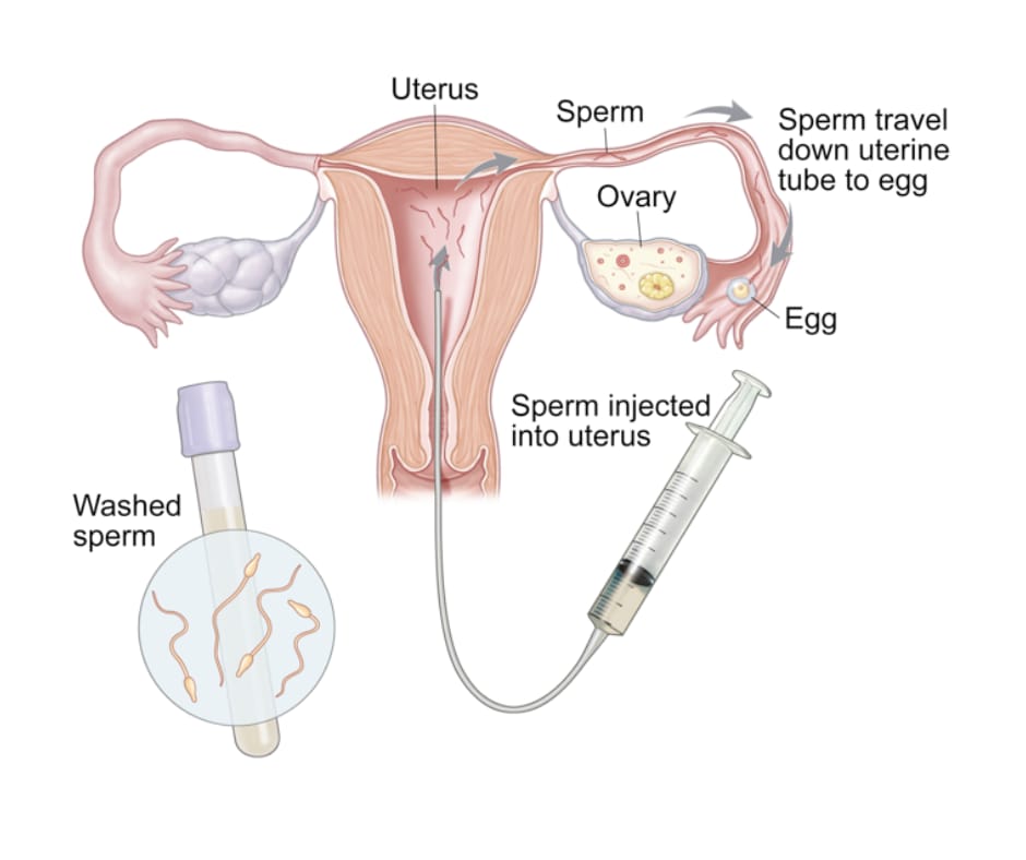 Intrauterine Insemination (IUI)