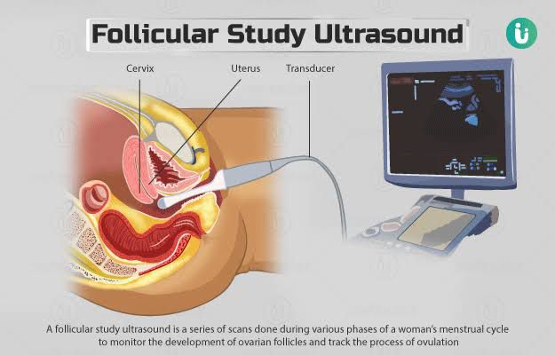 Ultrasound and Ovulation