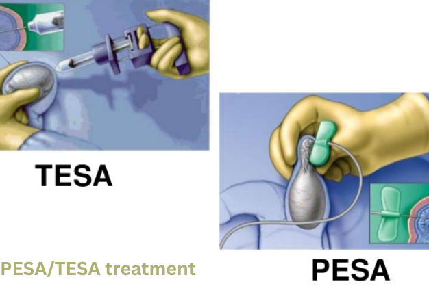 PESA/TESA Treatment at NWF