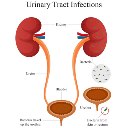 Urinary Tract Infection (UTI)