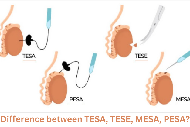 Difference between TESA, TESE, MESA, PESA?