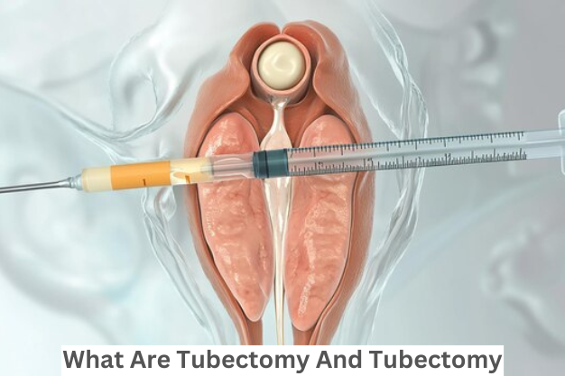 What are Tubectomy and Tubectomy Reversal?