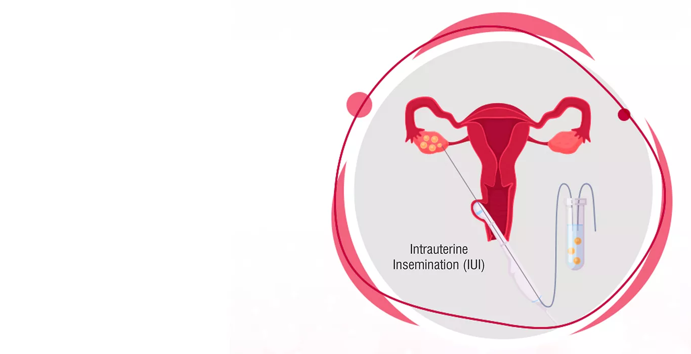 What Is IUI? Everything You Need to Know About Intrauterine Insemination