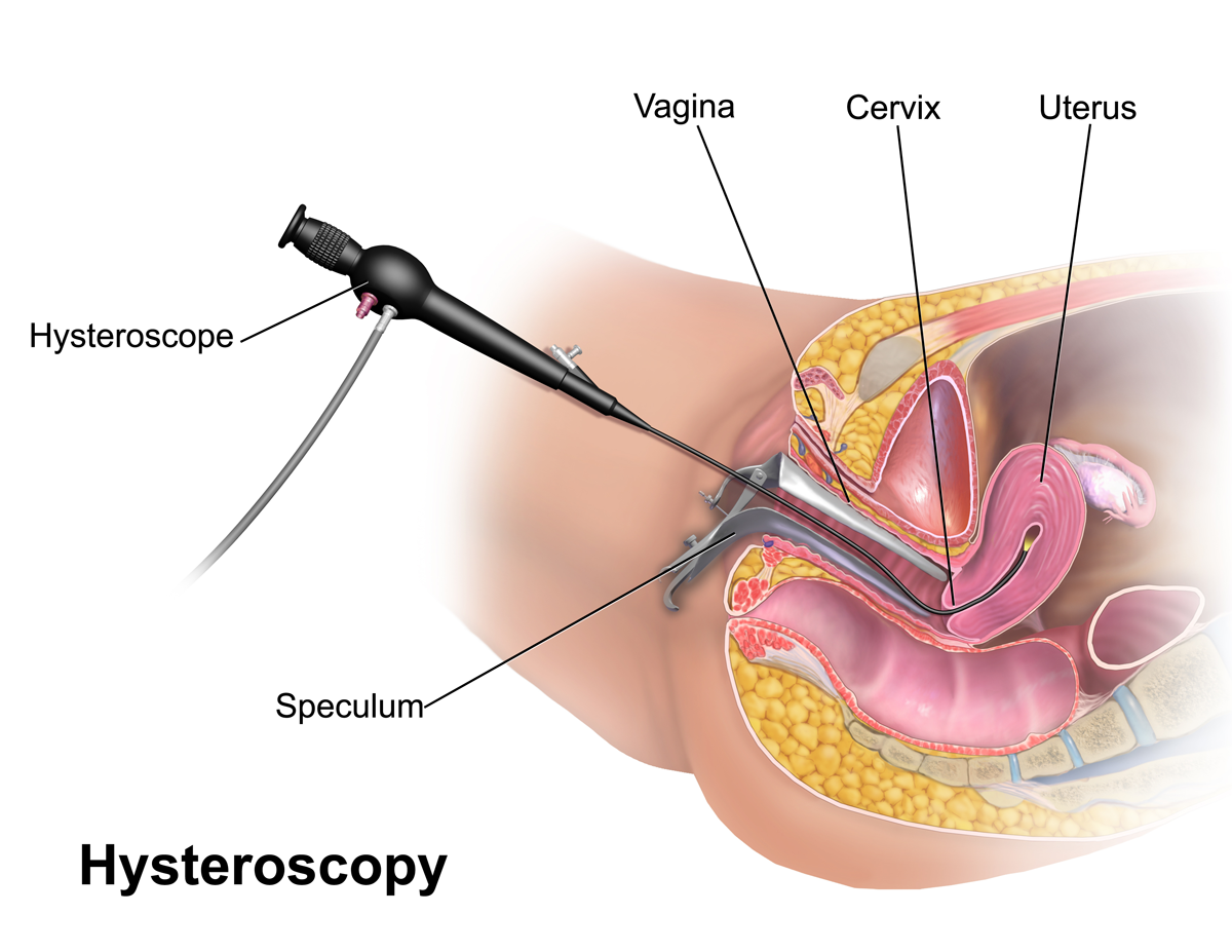 Hysteroscopy Treatment: A Breakthrough in Uterine Care