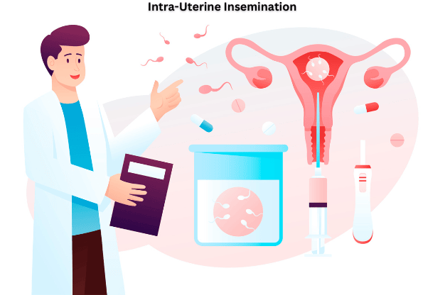 IUI Treatment: Success Rates, Procedure, Costs & Everything You Need to Know