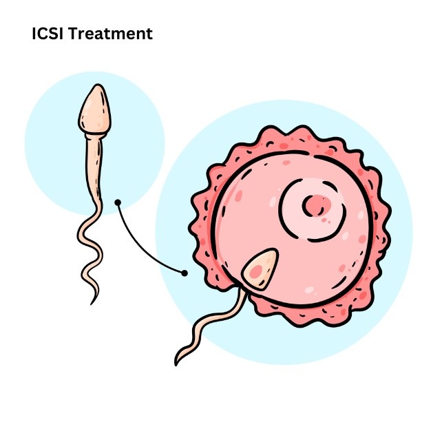 ICSI Treatment in Delhi: Process, Cost & Success Rate