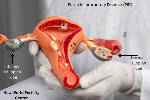 Pelvic Inflammatory Disease (PID): Causes, Symptoms & Treatment