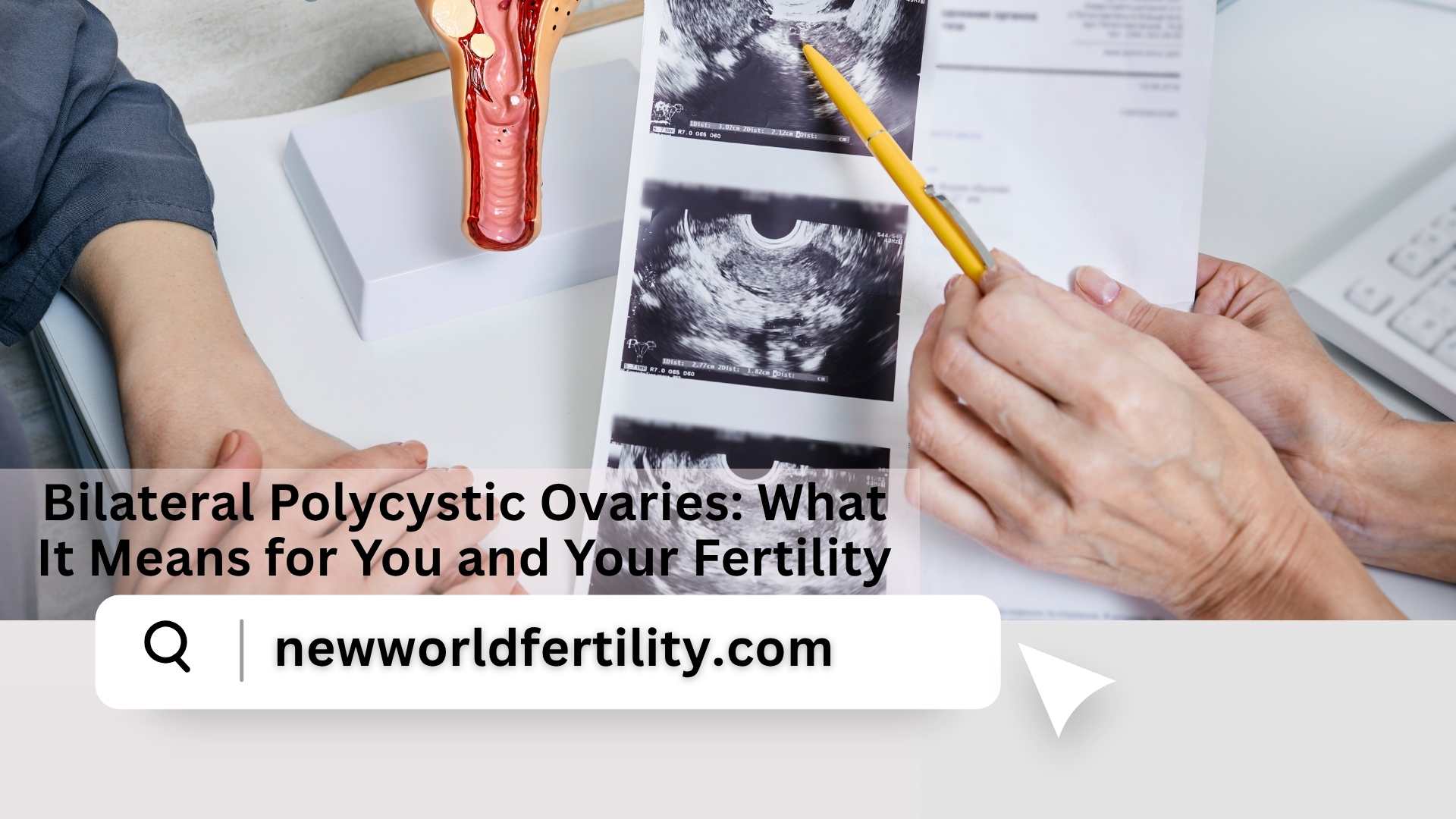 Bilateral Polycystic Ovaries: What It Means for You and Your Fertility